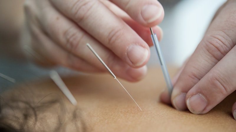 Acupuncture needles being placed as part of pain treatment
